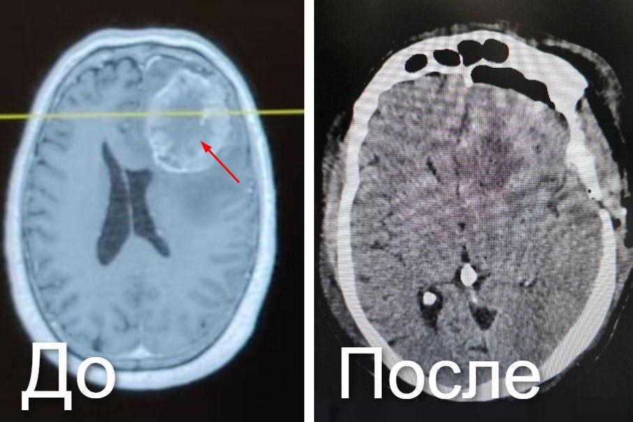 «Ювелирную» операцию под микроскопом на мозге провели хирурги в Новокузнецке «Ювелирную» операцию под микроскопом на мозге провели хирурги в Новокузнецке