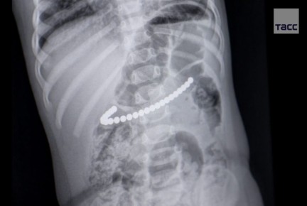 Врачи в Кемерове спасли годовалую девочку, которая проглотила 24 магнитных шарика, сообщает министр здравоохранения региона Андрей Тарасов