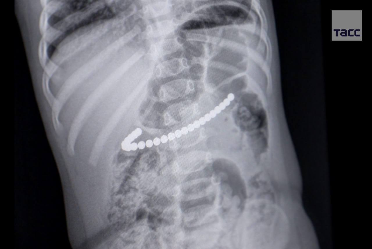 Врачи в Кемерове спасли годовалую девочку, которая проглотила 24 магнитных шарика, сообщает министр здравоохранения региона Андрей Тарасов